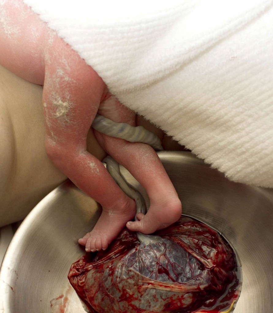 Delayed Cord Clamping with Placenta